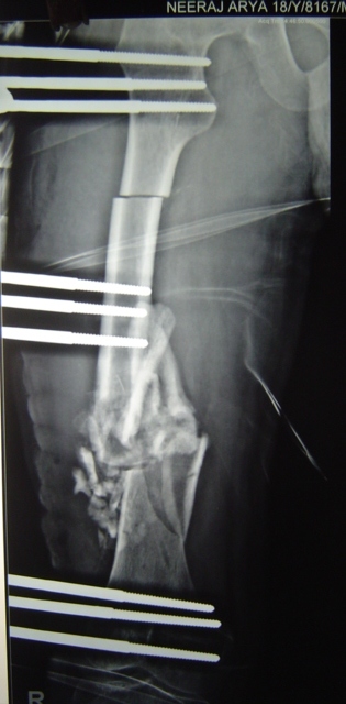 6 X Ray immediately after surgery 1