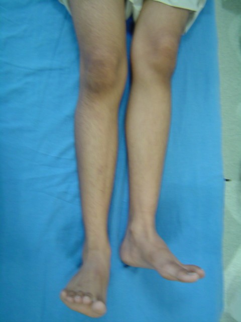 1 Short leg before surgery 1